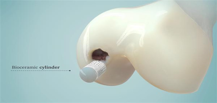 3d-printed-bioceramic-implants-for-bone-repair-enter-market-soon